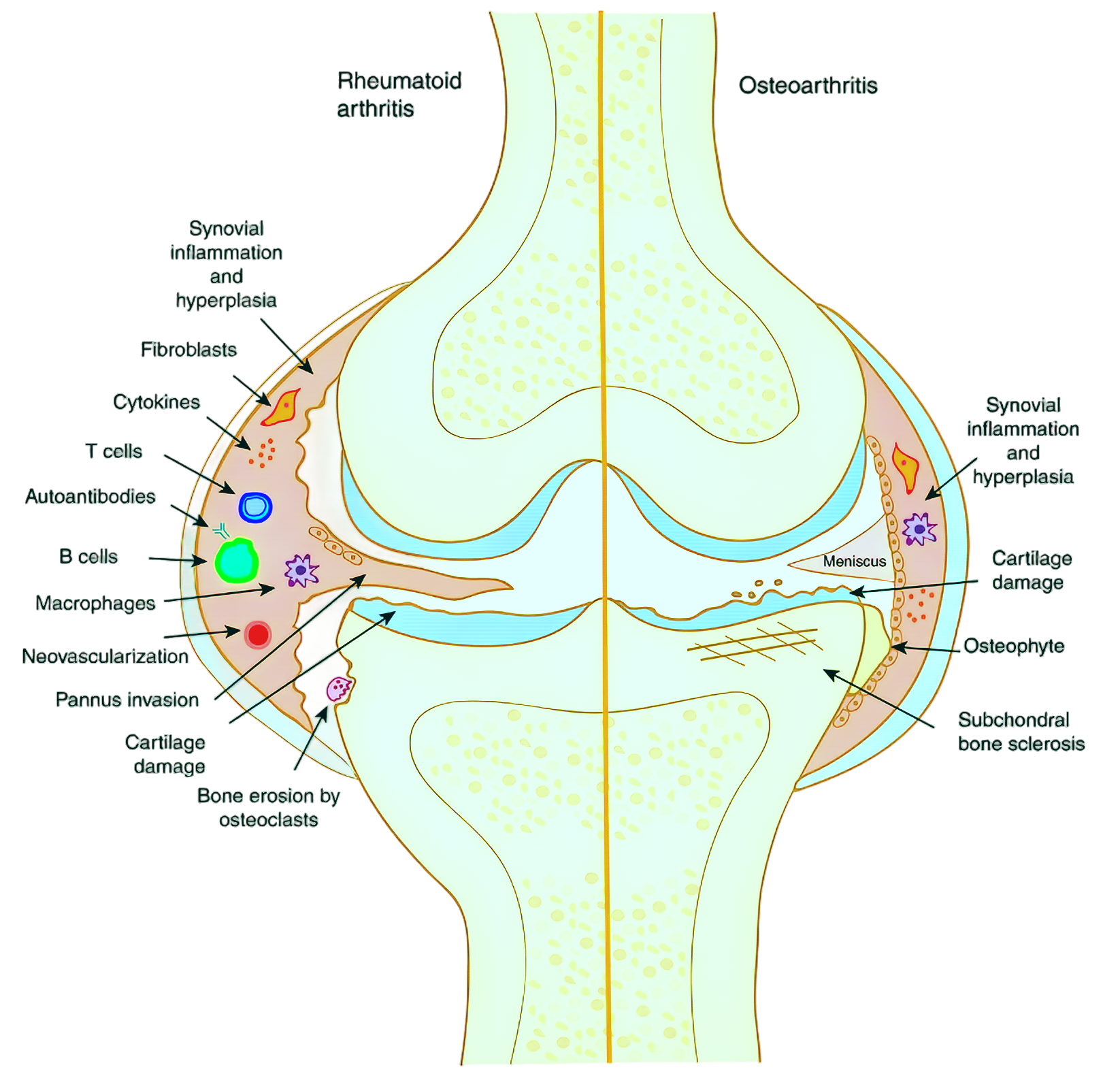 Research Progress on Cartalax in the Treatment of Osteoarthritis and the Repair of Cartilage Damage